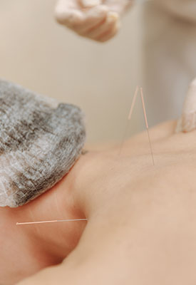 Acupuncture