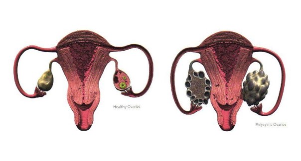 PCOS Specialist Melbourne