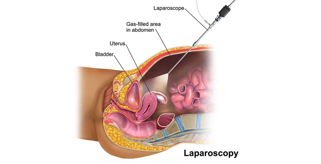 Laparoscopy diagram
